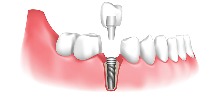 Dental implant