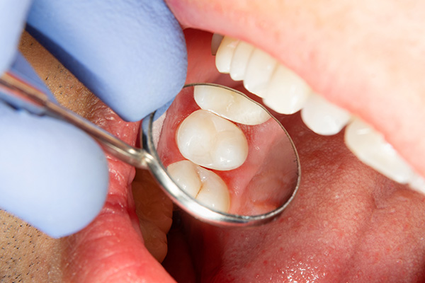 How do root canals work