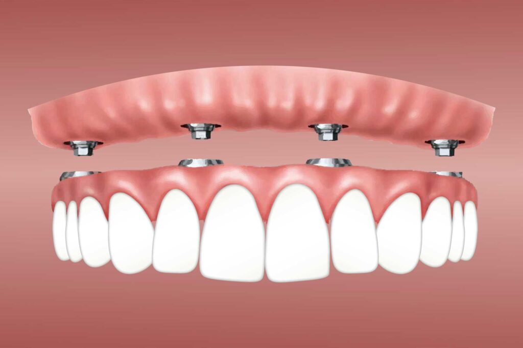 What are dental implants