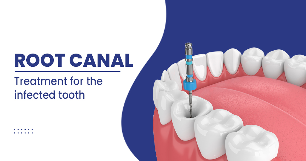 Root Canal Therapy in Burnaby