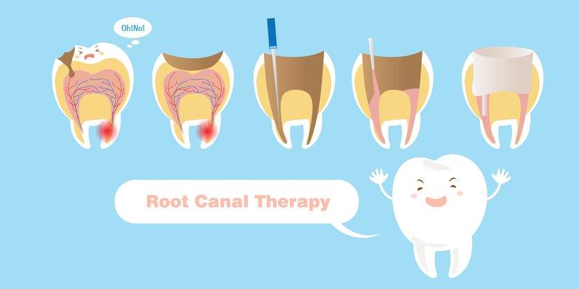 Root Canal Therapy