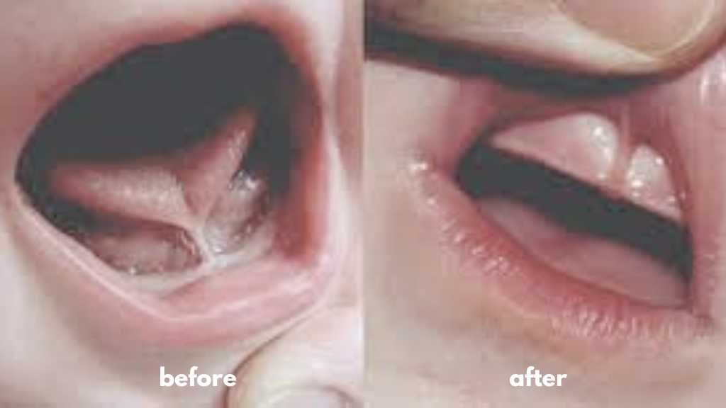 Burnaby tongue tie frenectomy dentist