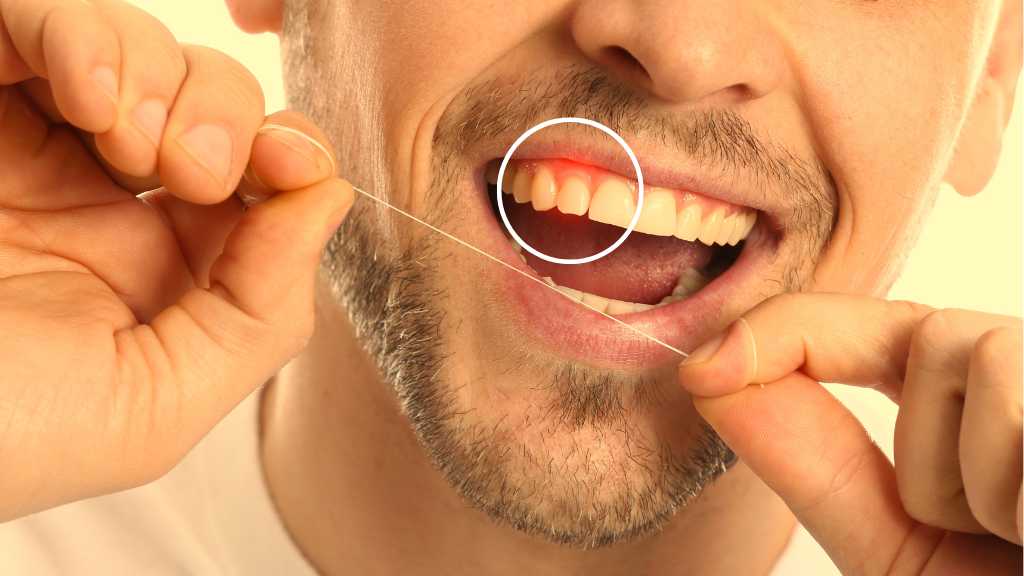 Gum Disease Burnaby