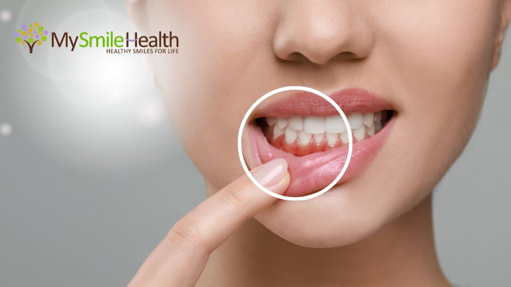 gum-disease-burnaby