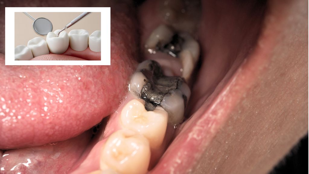 burnaby-dental-filling-white