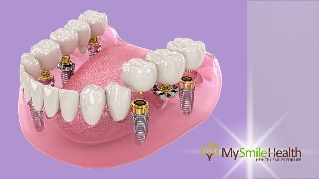 burnaby-dental-implant-restoration