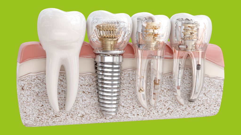 burnaby-dental-implant-restorations