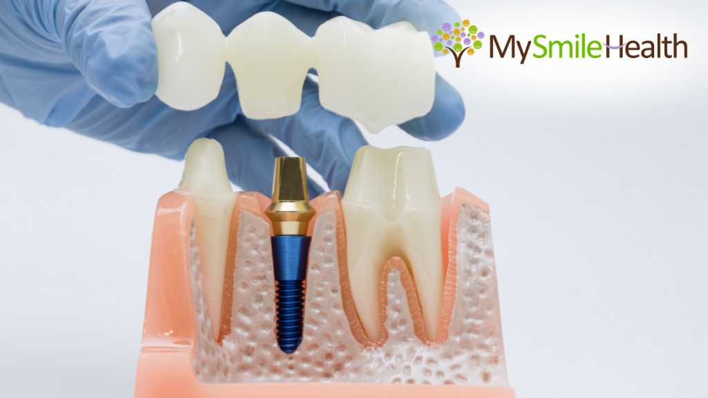 burnaby-dentist-dental-crowns