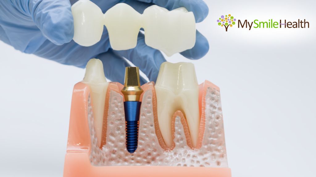 crowns-bridges-burnaby-dentist-healthy-smiles-dentistry